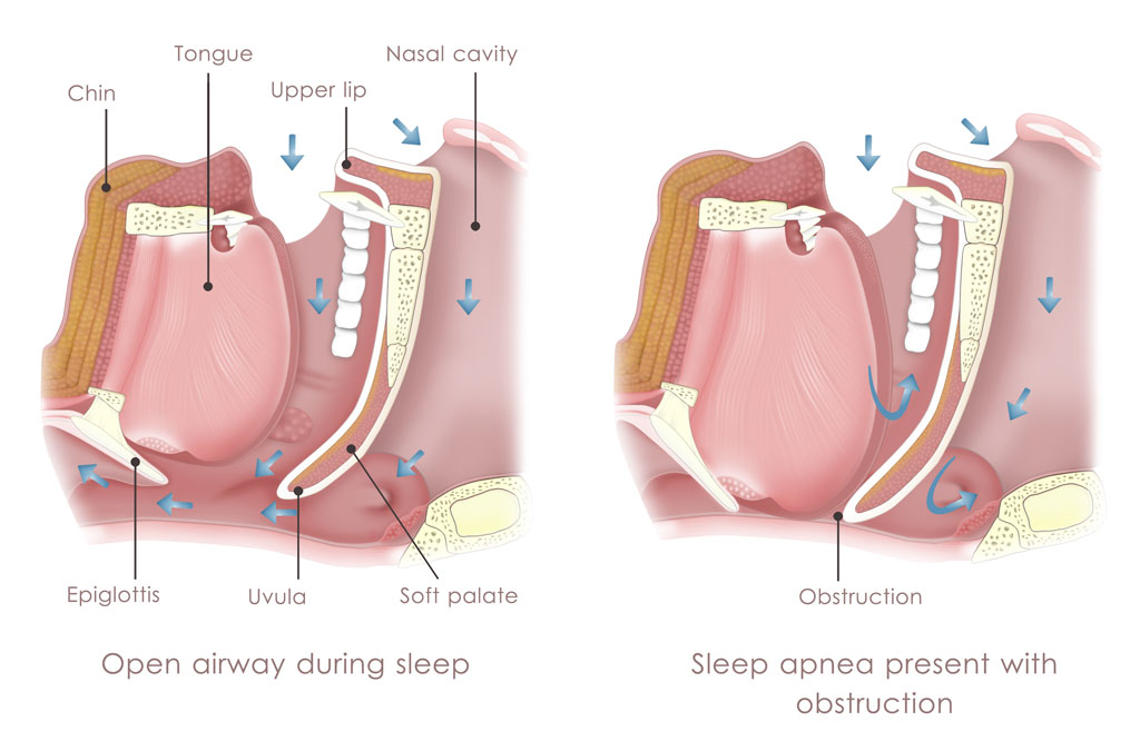 Obstructive Sleep Apnea Symptoms Diagram